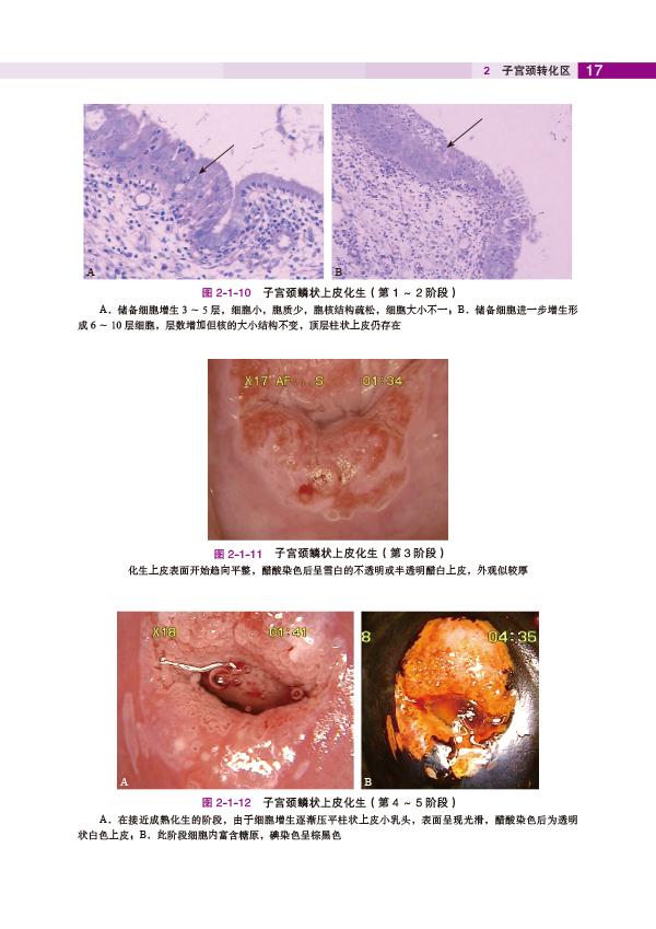 子宫颈转化区特征(2)--《子宫颈疾病——阴道镜图释》