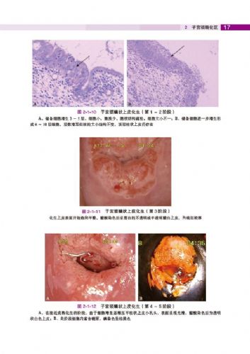 子宫颈转化区特征(2《子宫颈疾病—阴道镜图释》