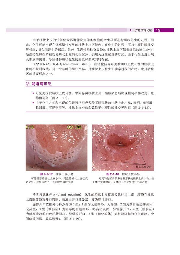 子宫颈转化区特征(2《子宫颈疾病—阴道镜图释》